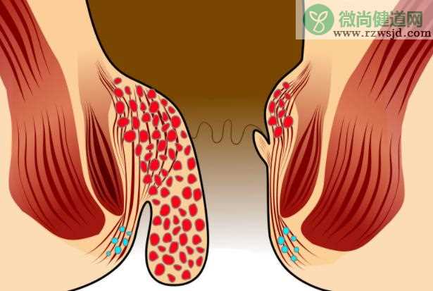 痔疮便血能自愈吗 痔疮喷射
