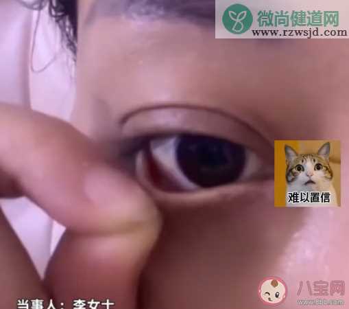 女子3千割眼袋3个月眼睛闭不合 割眼袋有哪些注意事项