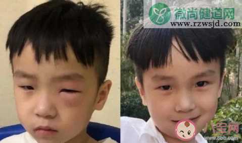 被蚊子叮过最尴尬的位置是哪 被蚊子咬了怎么止痒