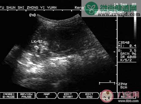 彩超的图像看起来还是黑白这正常吗 蚂蚁庄园10月23日答案最新