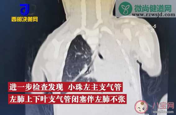 1岁娃吃松子摔倒卡进气管脸