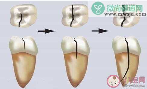 蚂蚁庄园虫牙是因为牙齿中有虫吗 8月20日答案介绍