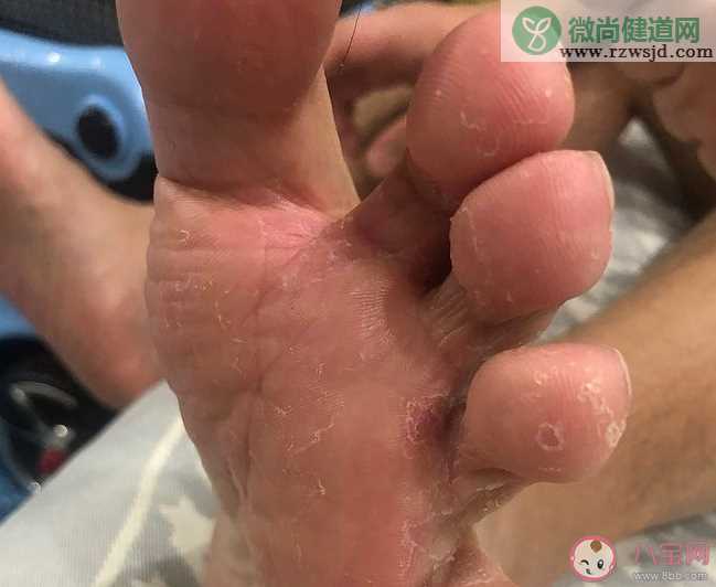 脚气是怎么引起的 有脚气怎