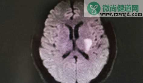 针刺脑卒中患者放血减轻病情靠谱吗 蚂蚁庄园12月2日答案