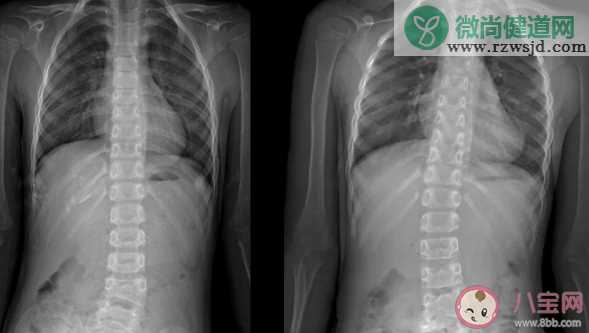 孩子脊柱侧弯是什么原因造成的 脊柱侧弯有哪些影响