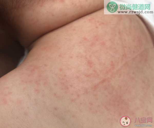 孩子洗澡水里滴去痱水有用吗 夏天怎么预防宝宝起痱子