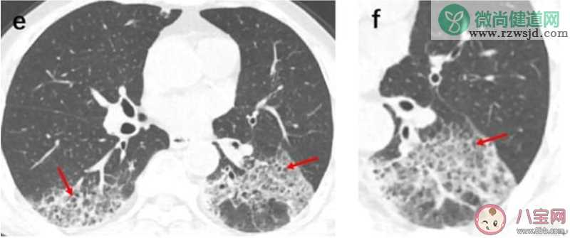 新冠肺炎患者的肺和SARS患者的区别是什么 新冠肺炎患者的肺和SARS患者的有哪些区别