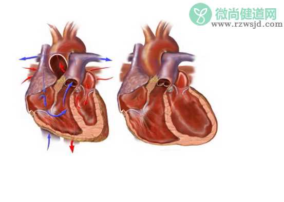 病毒性心肌炎有后遗症吗 病