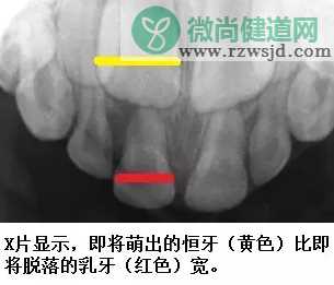 宝宝牙齿有缝怎么办   牙齿有缝正常吗