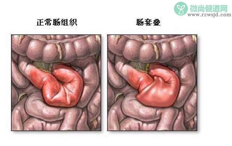 宝宝得了肠套叠怎么办 小儿