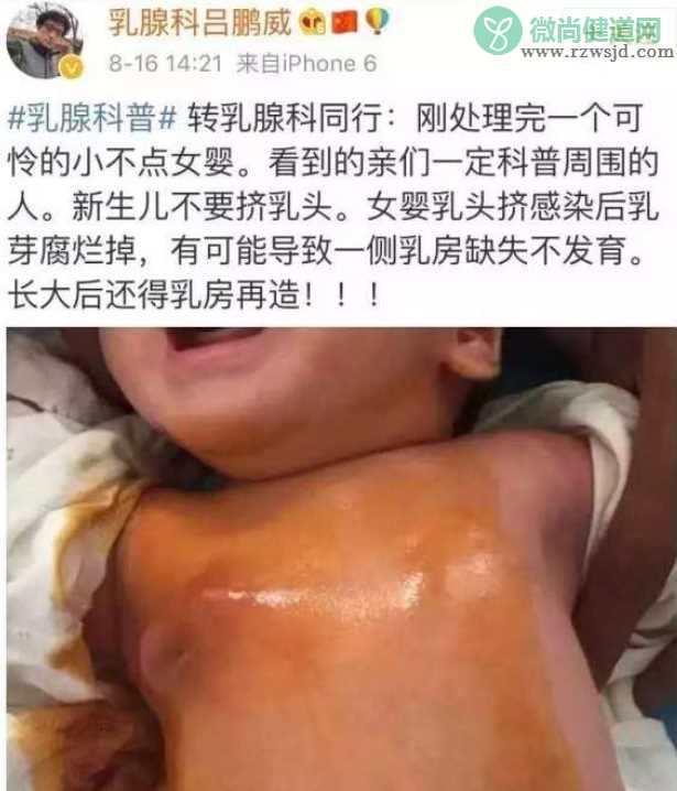 新生儿乳头需要挤吗 给新生儿挤乳头的危害