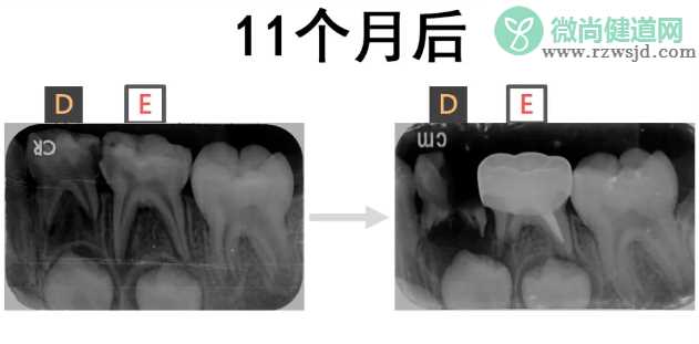 儿童牙齿保健的方法 怎么保护好孩子的牙齿健康