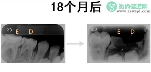 儿童牙齿保健的方法 怎么保护好孩子的牙齿健康