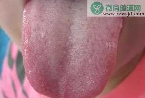 孩子阴虚火旺的症状有哪些 孩子阴虚火旺怎么调理