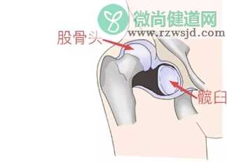 宝宝髋关节发育不良怎么办 髋关节发育不良的危害