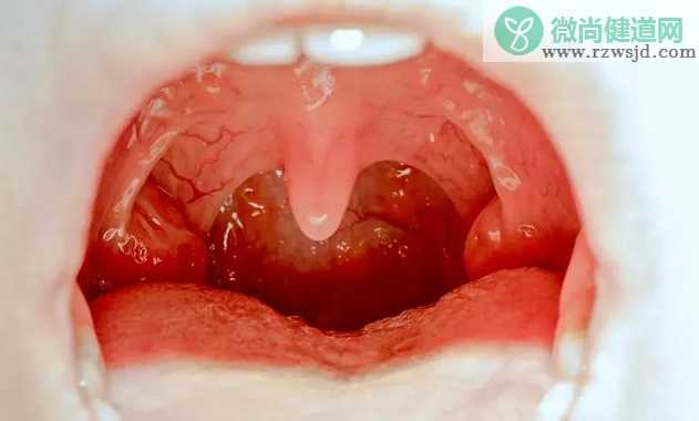 扁桃体大就一定是扁桃体炎吗 扁桃体发炎有哪些症状