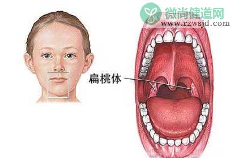 宝宝扁桃体自救指南 怎么保护孩子扁桃体