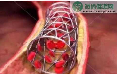 心脏支架将大幅降价是怎么回事 心脏支架为什么大幅降价