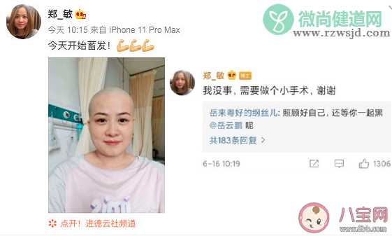 岳云鹏老婆为什么剃光头 剃光头是得了什么病