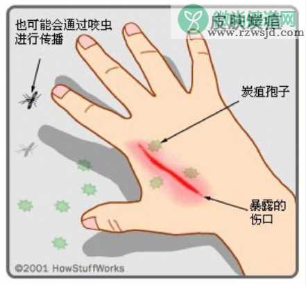 黑龙江感染炭疽病有多少人 黑龙江感染炭疽疫情是怎么回事