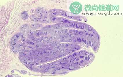 孩子出现打呼噜严重吗 孩子