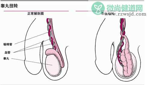 睾丸扭转是什么意思 如何自测睾丸扭转