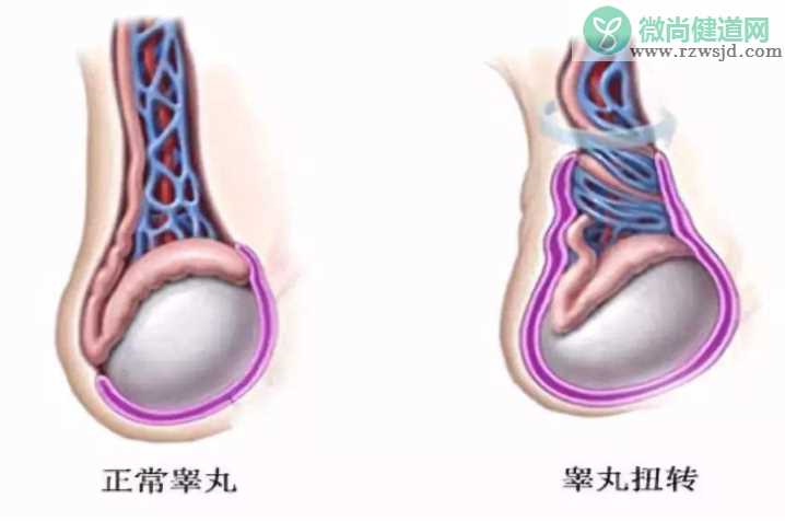 睾丸扭转会影响生育功能吗 