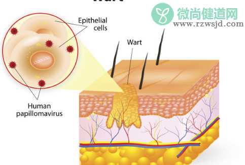 尖锐湿疣是性病吗 尖锐湿疣能根治吗