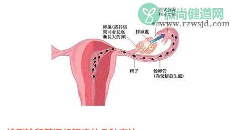 输卵管不通怎么办 输卵管不通如何助孕