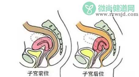 子宫后位的影响有哪些 子宫后位会导致不孕吗