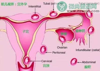 预防宫外孕的运动有哪些 跳绳能够预防宫外孕吗