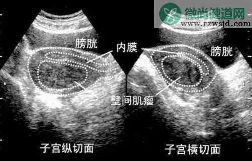 患上子宫肌瘤不想开刀能怀孕吗 子宫肌瘤的影响有哪些