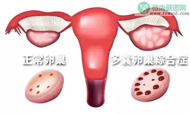 多囊患者可以自然排卵吗 多囊患者能自然怀孕吗