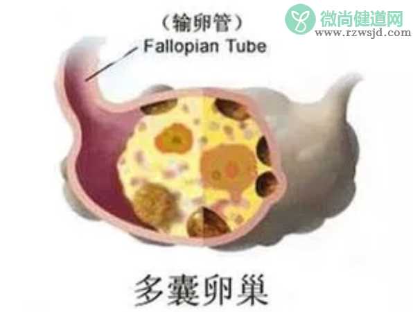 卵巢多囊样改变会影响怀孕吗 多囊卵巢综合症好怀孕吗