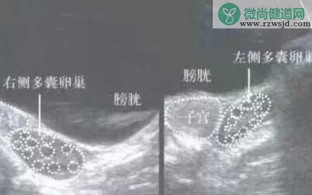 卵巢多囊样改变和多囊综合征区别 卵巢多囊样改变是什么