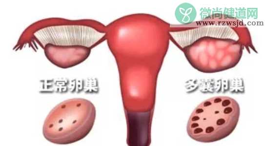 卵巢多囊样改变和多囊综合征区别 卵巢多囊样改变是什么