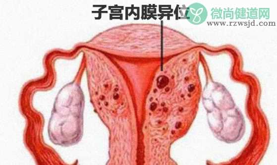 子宫内膜异位症还能怀孕吗 女性子宫内膜异位症严重吗