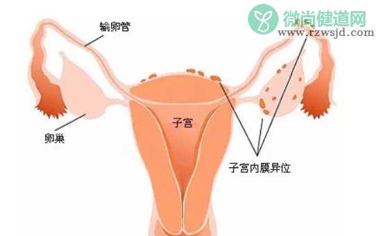 子宫内膜异位症手术后能怀孕