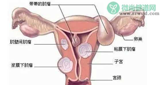 子宫发育不良能治愈吗 子宫发育不良不来月经怎么办