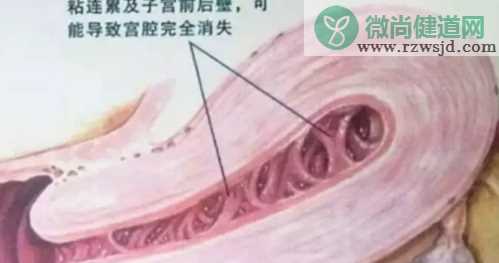 宫腔粘连是怎么回事 宫腔粘