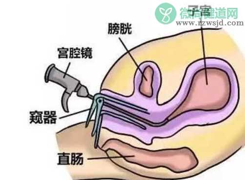 宫腔镜检查后多久可以同房 