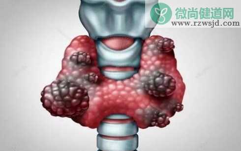 甲状腺怀孕影响胎儿吗 甲状