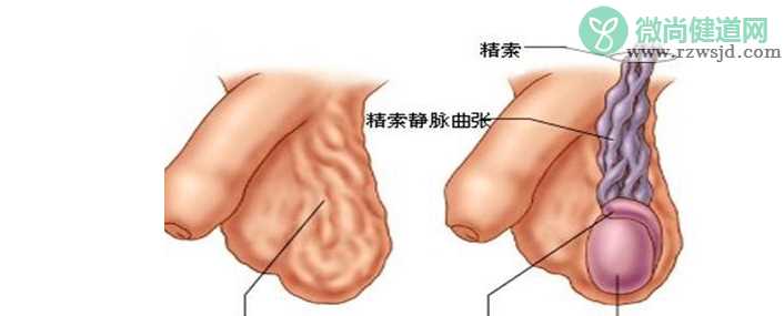 精索静脉曲张更容易发生在左侧蛋蛋吗 左侧精索静脉曲张会引发右侧精索静脉曲张吗