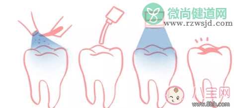 宝宝蛀牙不给医生看 如何预防蛀牙减少宝宝痛苦