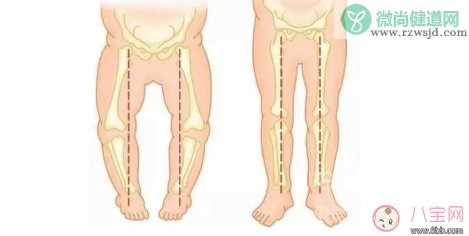 穿纸尿裤会让孩子O型腿吗 如何预防宝宝O型腿
