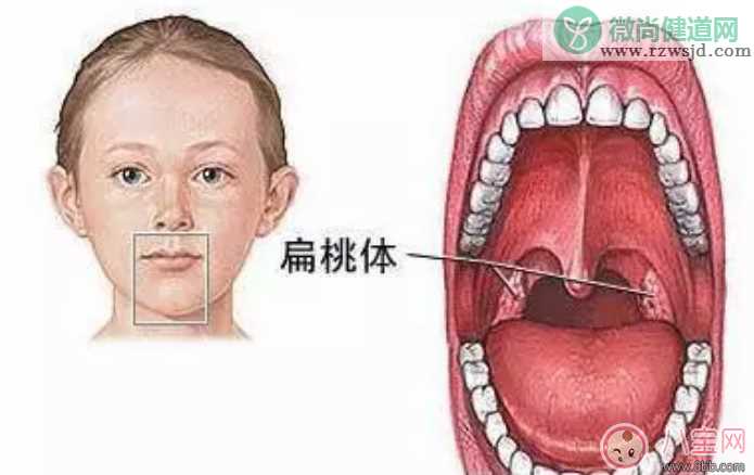 宝宝扁桃体发炎发烧不止怎么办 扁桃体到底该不该切