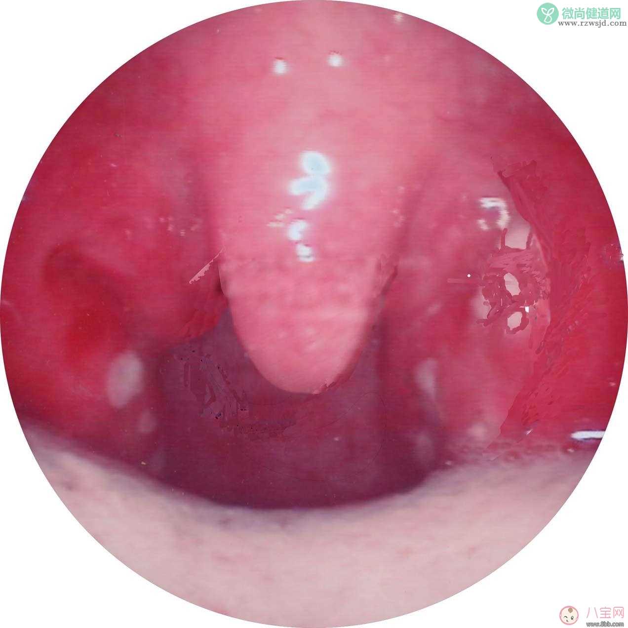 为什么孩子反复扁桃体化脓 急性化脓性扁桃体炎怎么回事
