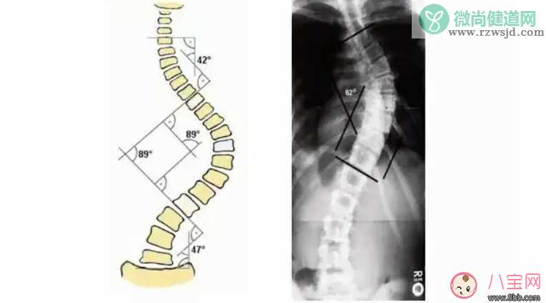 孩子总低头玩王者荣耀会脊椎侧弯吗   如何检查宝宝是否脊椎侧弯
