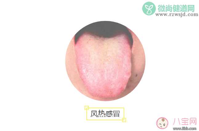 宝宝风寒感冒和风热感冒舌头对比图 感冒舌头上黄舌苔是风热感冒吗