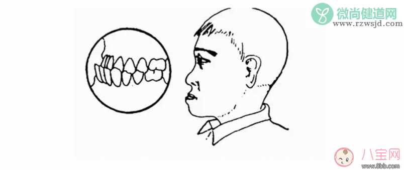 宝宝宝宝喜欢张着嘴巴呼吸怎么办   哪些行为会让孩子变丑